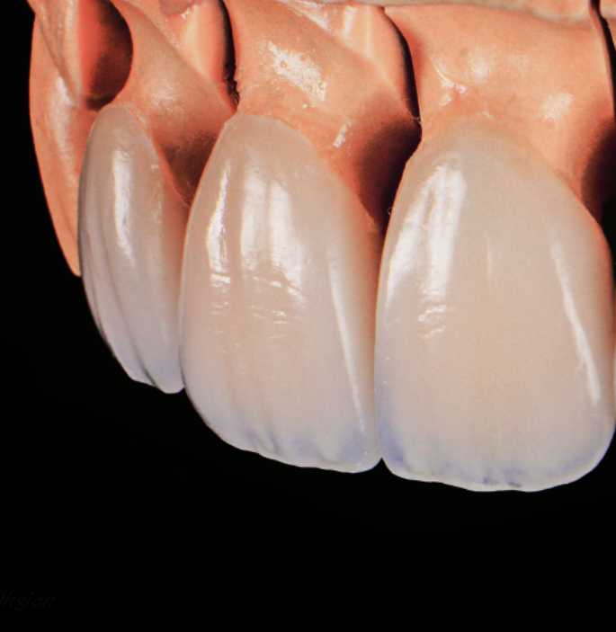 veneers-andover