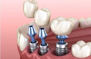 andover-dental-implants-hampshire
