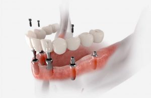 dental-implants-andover