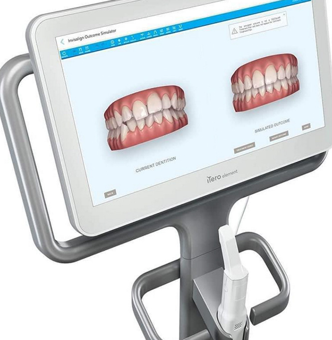 iTero-Scan-Andover-Advanced-Dental-Clinic.jpg